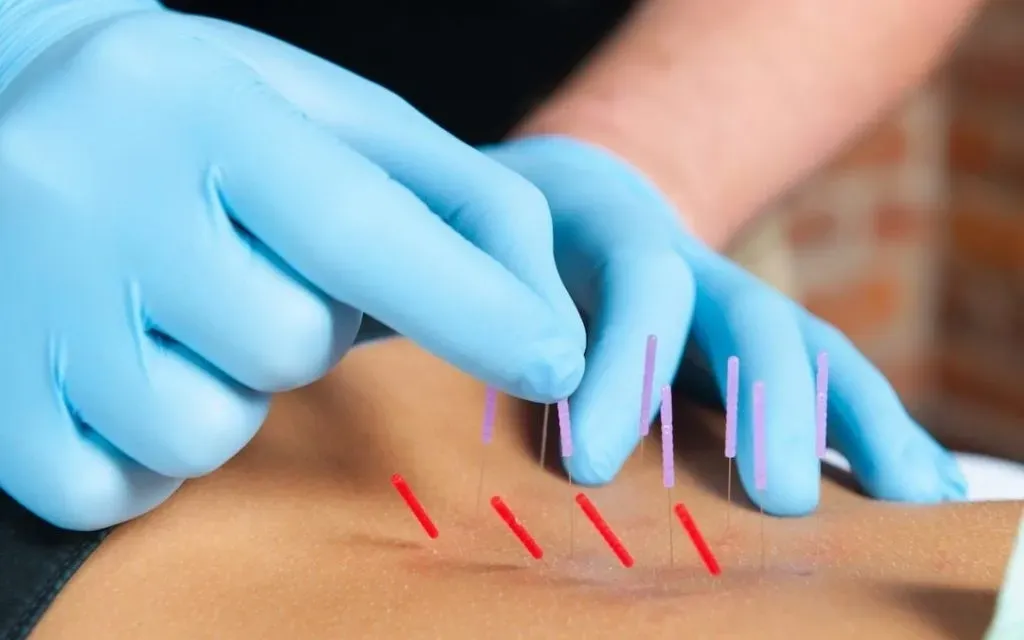 Get Relief with IMS/Dry Needling